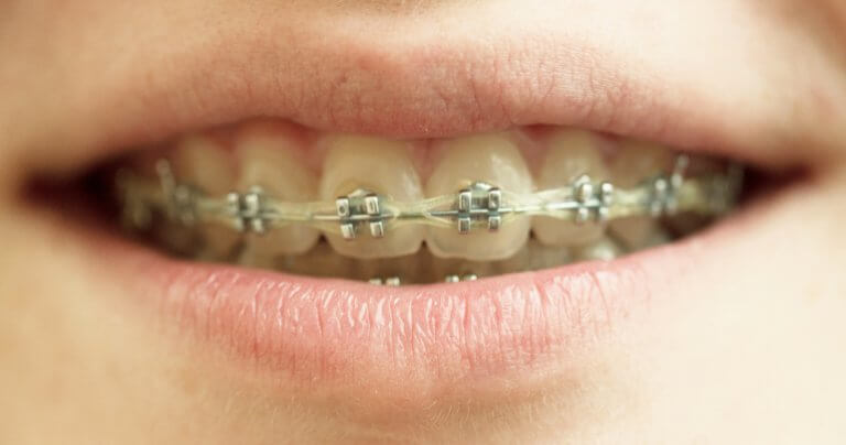Maxillary bone motion - dentistry - zero-second brain cycle - girl with braces - closeup - Gillespie Approach–Craniosacral Fascial Therapy