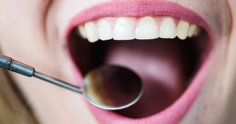 Palatal expansion - open mouth - woman at dentist - Gillespie Approach–Craniosacral Fascial Therapy