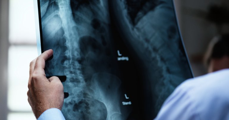 Scoliosis, kyphosis and lordosis - doctor holding X-rays - Gillespie Approach–Craniosacral Fascial Therapy