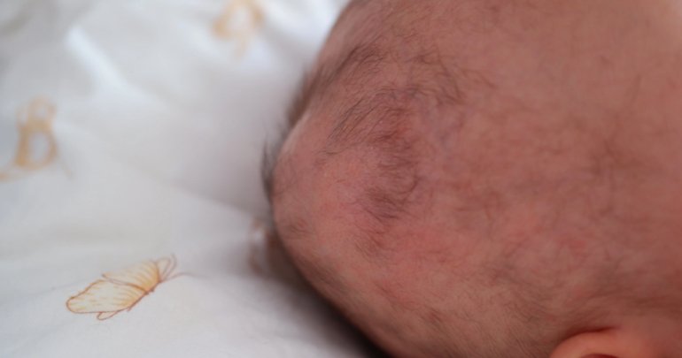 Newborn hematoma - baby in bed - Gillespie Approach–Craniosacral Fascial Therapy