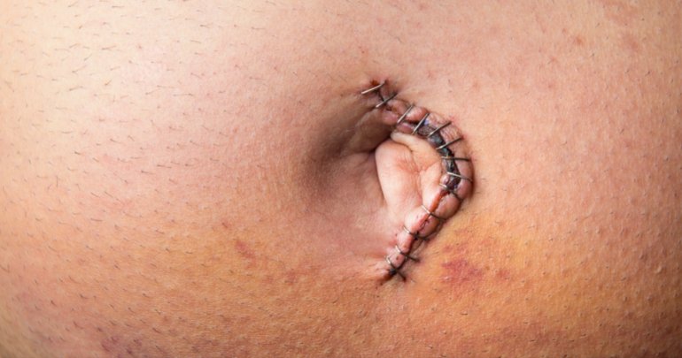 Gallbladder surgery and the fascial web - surgical scar closeup - Gillespie Approach–Craniosacral Fascial Therapy