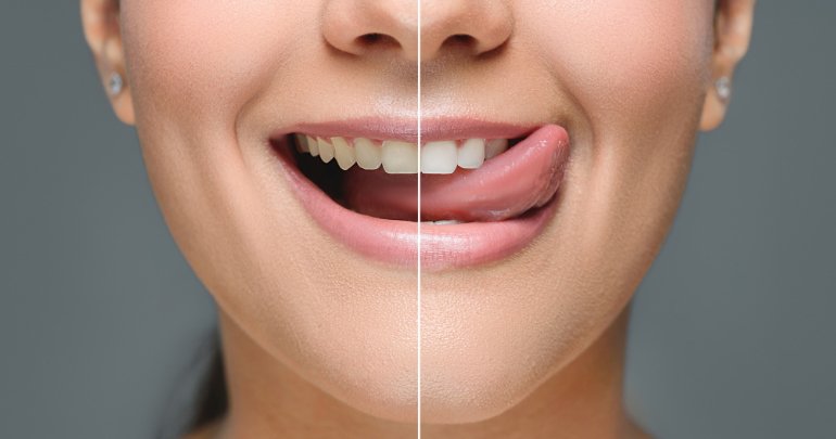 Tongue tie providers - woman with tongue showing - Gillespie Approach–Craniosacral Fascial Therapy